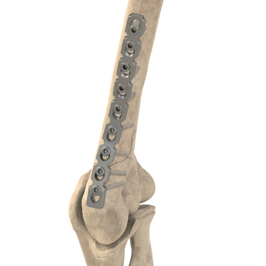 3.5 Reconstruction Plate