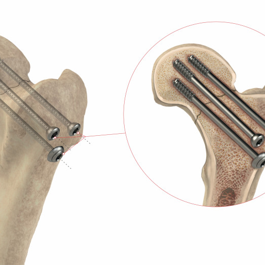 Ø7.3 Cannulated screw