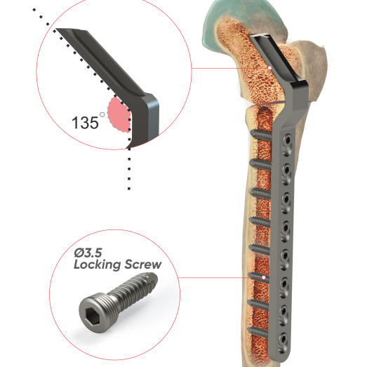 Angled Blade 135° Locking Plate