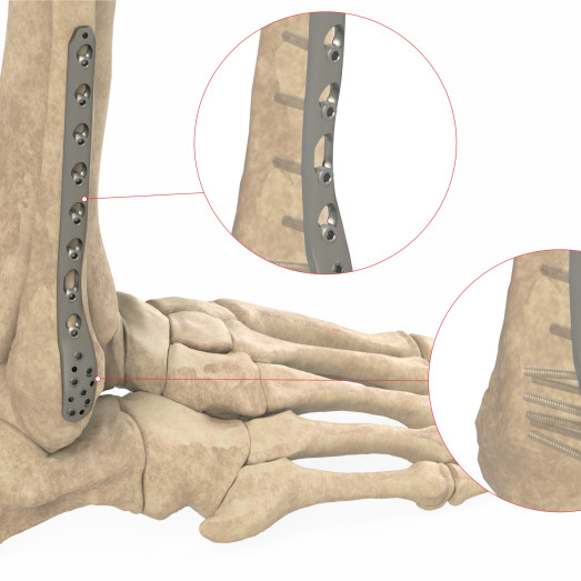 Distal Fibula III Locking Plate