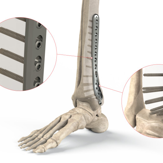 Distal Medial Tibial Point Plate