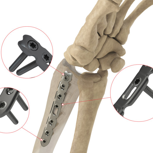 Distal Radius Lateral Plate