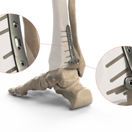 Distal Tibia Posterior Locking Plate II