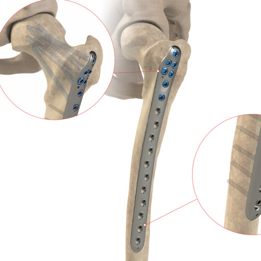 Proksimal Femoral Plate