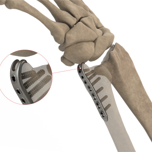 Ulnar Styloid Plate